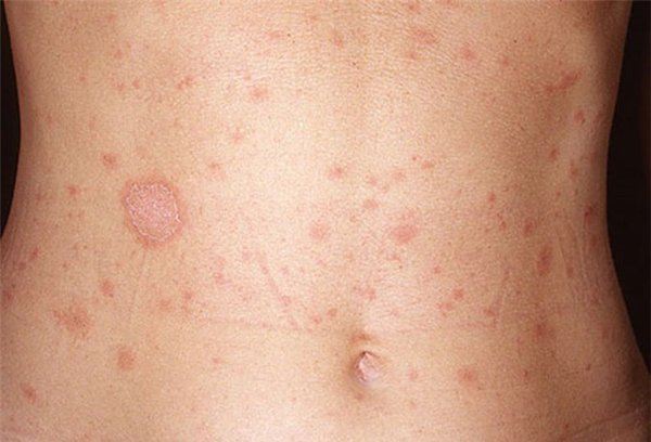 Nước điện giải làm hạn chế tình trạng nhiễm khuẩn, nhiễm trùng da...