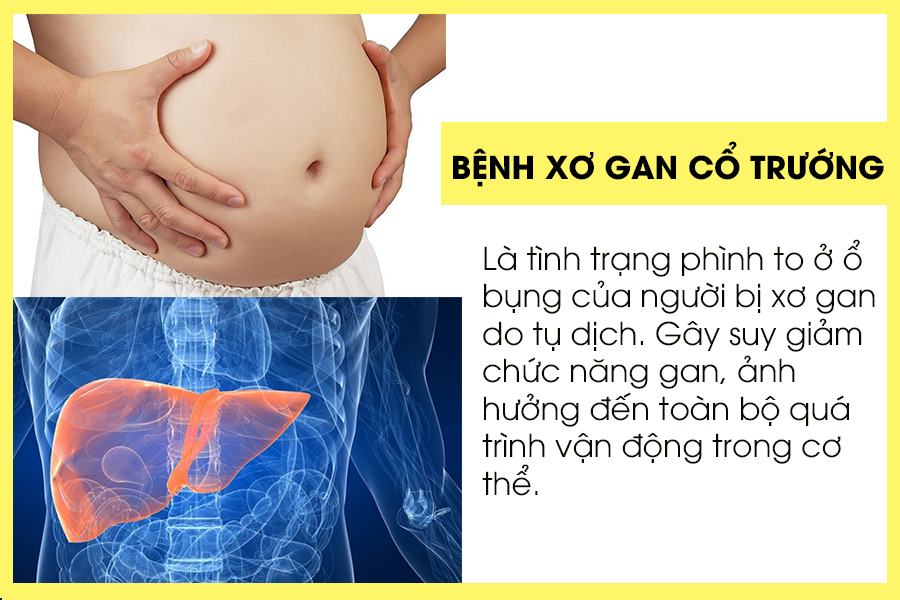 Xơ gan cổ trướng
