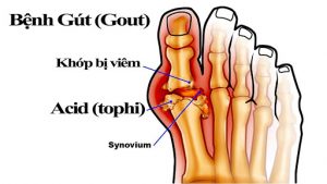 Bệnh gout: nhận biết dấu hiệu sớm, phòng tránh rủi ro cao