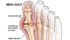 Bệnh gout: nhận biết dấu hiệu sớm, phòng tránh rủi ro cao