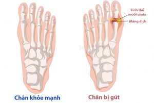 Bệnh gout: nhận biết dấu hiệu sớm, phòng tránh rủi ro cao