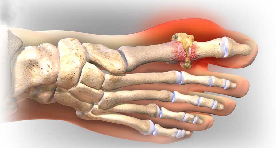 Bệnh gout gây sưng đau khớp