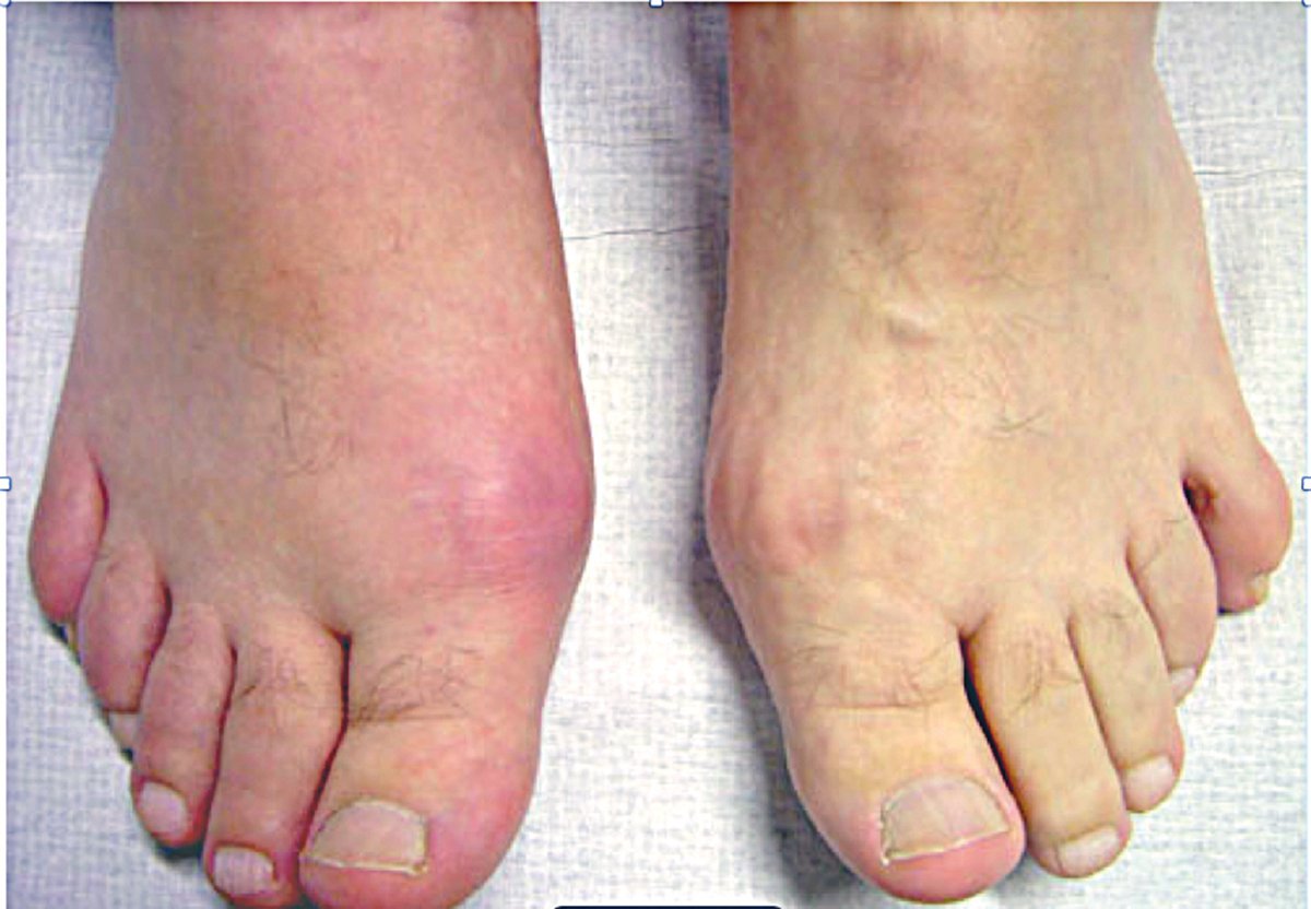 Bàn chân của người bị bệnh gút (gout)