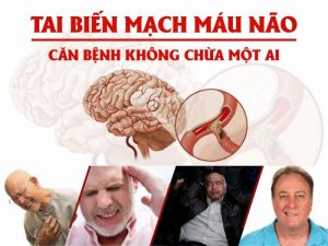 Tai biến mạch máu não - Căn bệnh không chừa một ai.