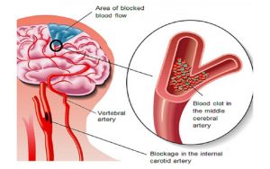 Tai biến mạch máu não - Nên làm gì để ngăn ngừa