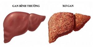 Gan bình thường - Xơ gan