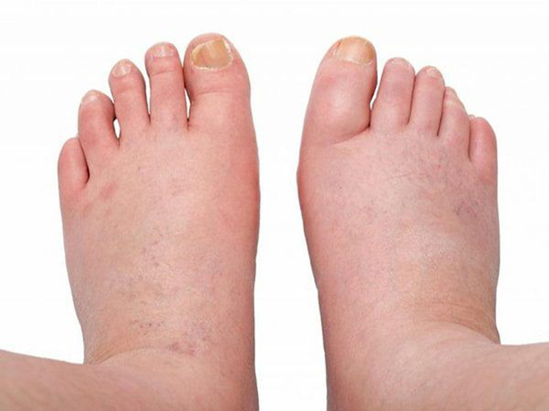 Phù chân và báng bụng