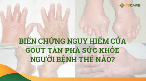 phòng tránh biến chứng nguy hiểm của bệnh gout
