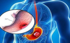 Ung thư dạ dày – căn bệnh đe dọa tính mạng người Việt