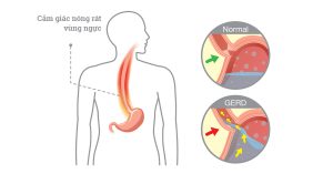 Trào ngược dạ dày