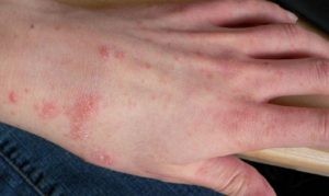 Bệnh ghẻ ngứa gây nhiều phiền toái trong cuộc sống