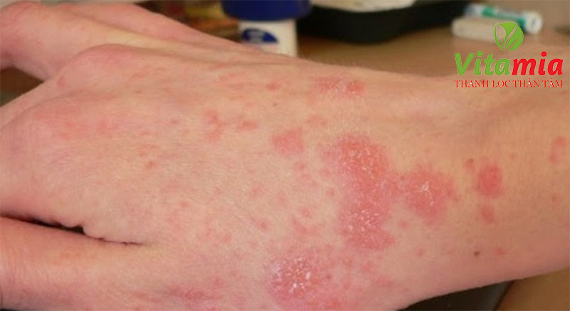 Nước điện giải điều trị bệnh viêm da cơ địa