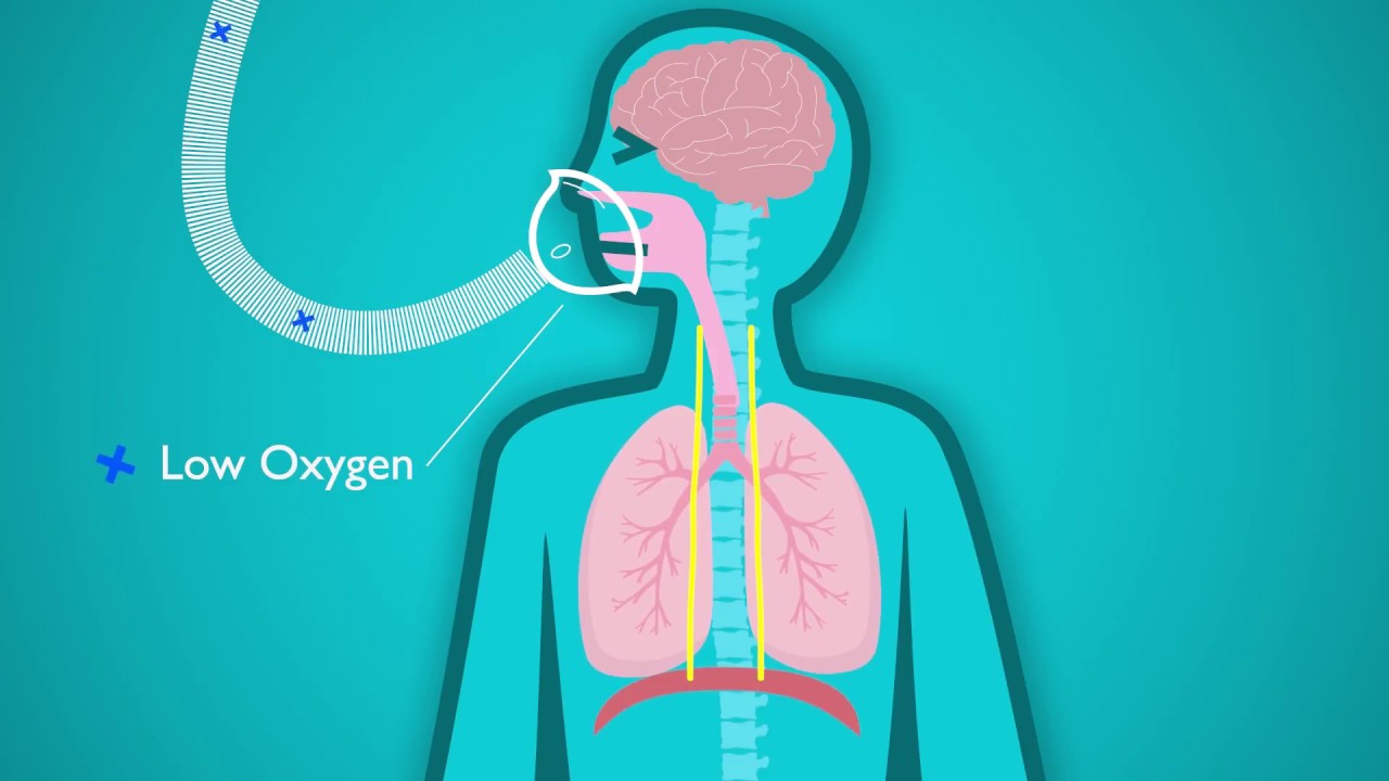 Thiếu oxy